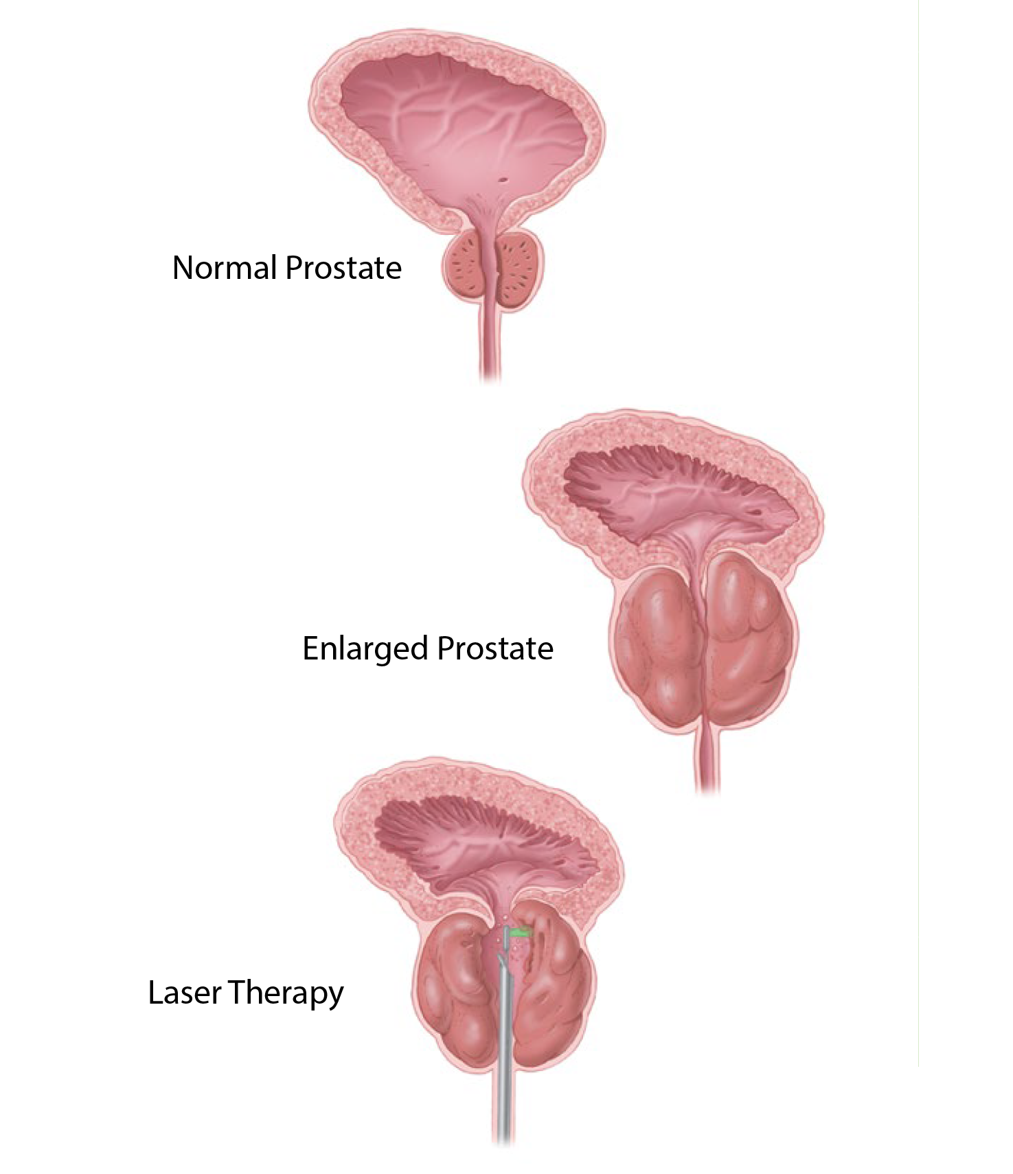 Normal Prostate versus Enlarged Prostate